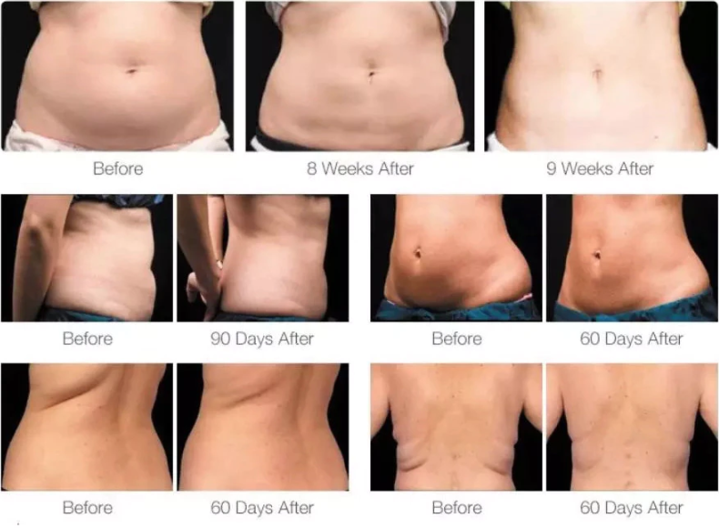 Aparat de slabit Criolipoliza Profesional Cryo-Terapie - imagine 4