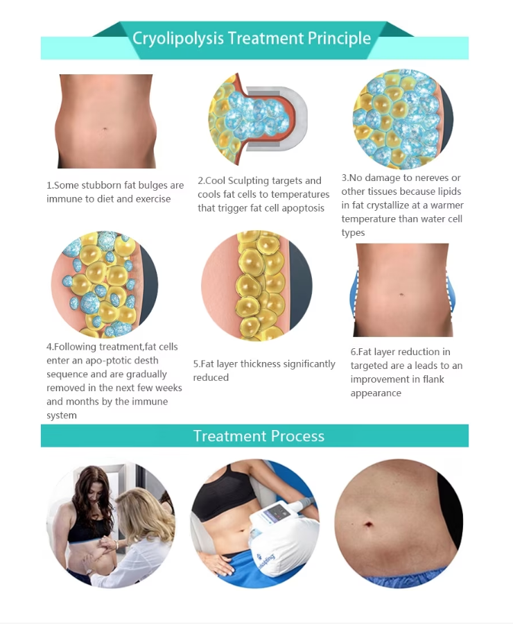 Aparat de slabit Criolipoliza Profesional Cryo-Terapie - imagine 6